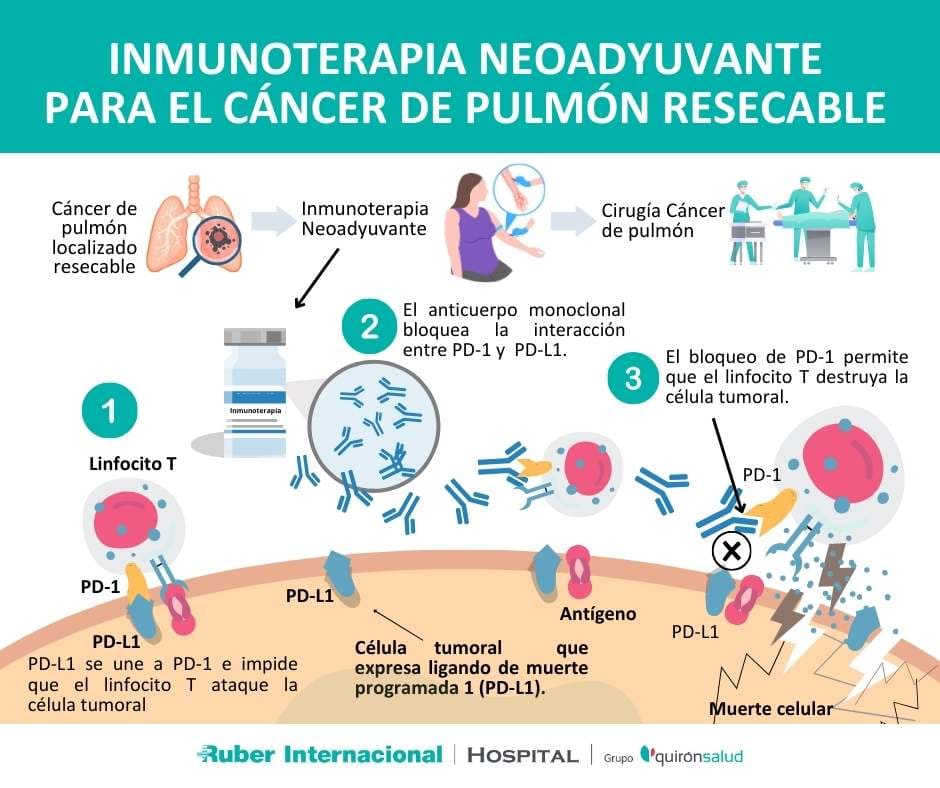 Tratamiento neoadyuvante inmunoterapia cancer de pulmon