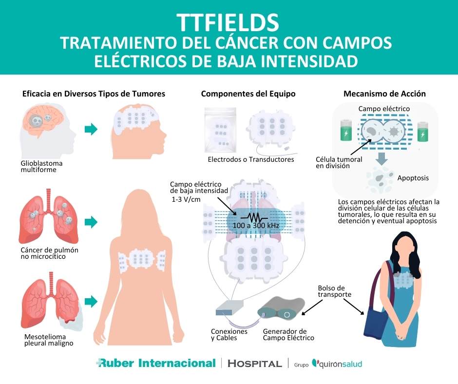 TTFields Campos eléctrico tratamiento tumor cáncer pulmón
