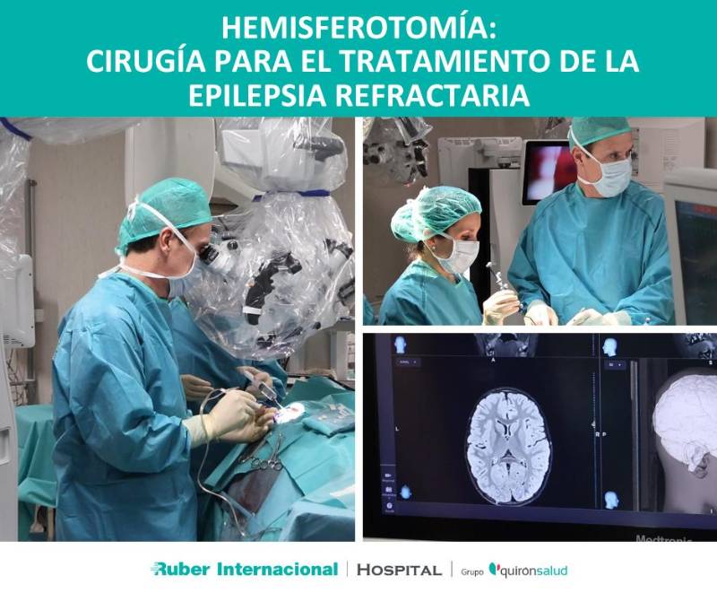 hemisferectomía hemisferotiomia cirugia epilepsia doctor budke