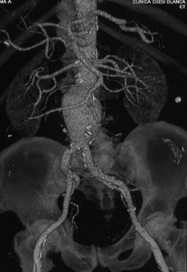 Imagen de TAC con contraste que muestra la dilatación de la aorta infrarrenal