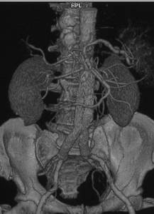 Reparación endovascular del AAA mediante la colocación de una endoprótesis a través de las arterias femorales