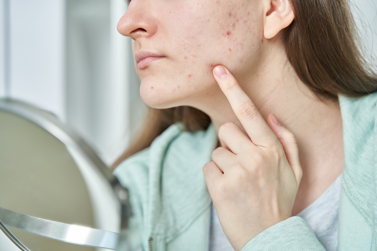 dermatologos especialistas en acne murcia