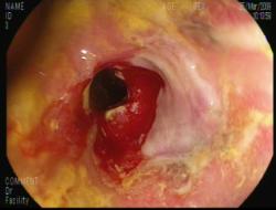 Estenosis rectal y úlcera actínica de recto