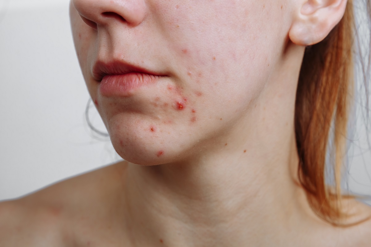 especialistas acne alicante