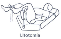 litotomía