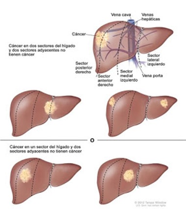 Metástasis hepáticas en cáncer de colon