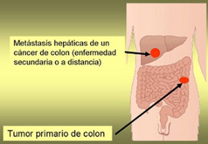 Metástasis hepáticas en cáncer de colon