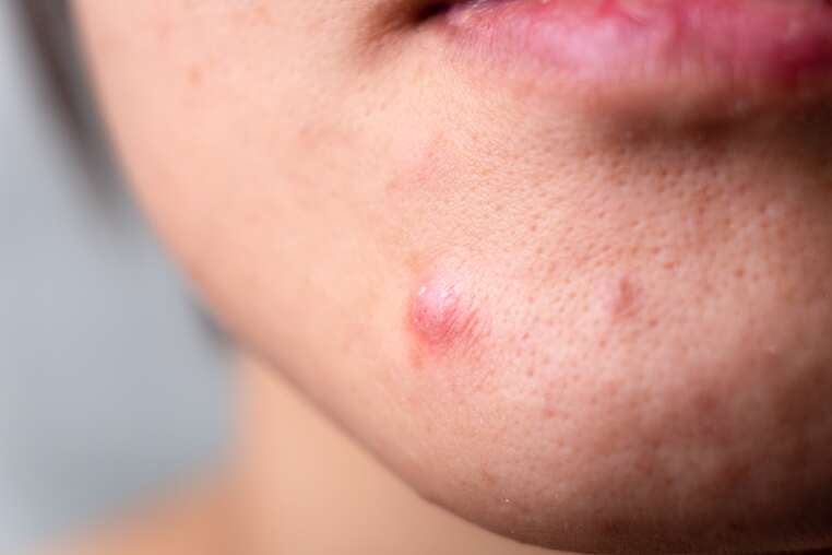 eliminar marcas de acne