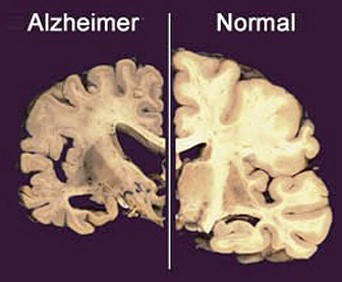Dolor y Alzheimer
