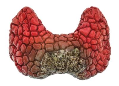 Tipos de carcinomas tiroideos