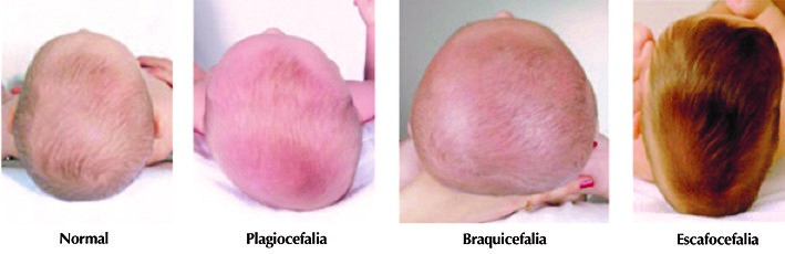 Plagiocefalia