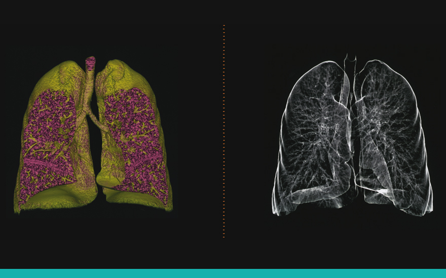 pulmones_cancer