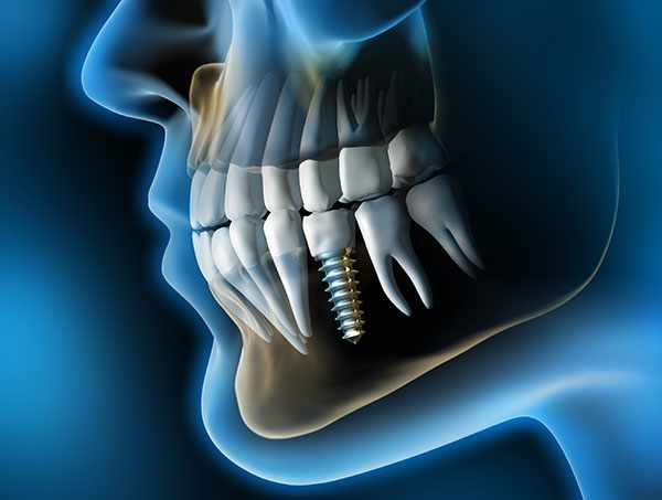 Qué son los implantes dentales y para qué se utilizan