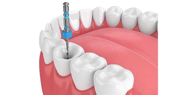 Qué es la endodoncia y para qué se utiliza