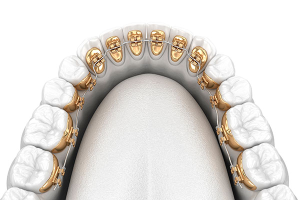 Ventajas-Ortodoncia-Lingual