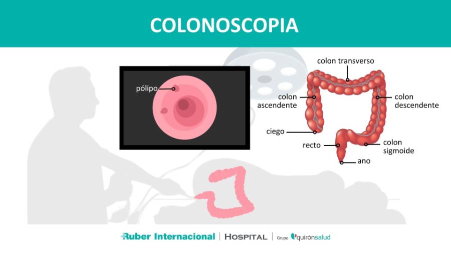 Colonoscopia