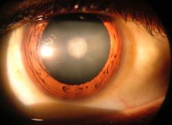 Un ojo humano con cataratas visto a través de una lámpara de hendidura