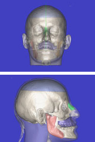 Nueva técnica de reconstrucción ósea maxilofacial inmediata