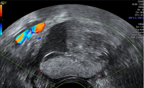 Ecografía transvaginal que muestra un teratoma o quiste dermoide del ovario de 47 mm