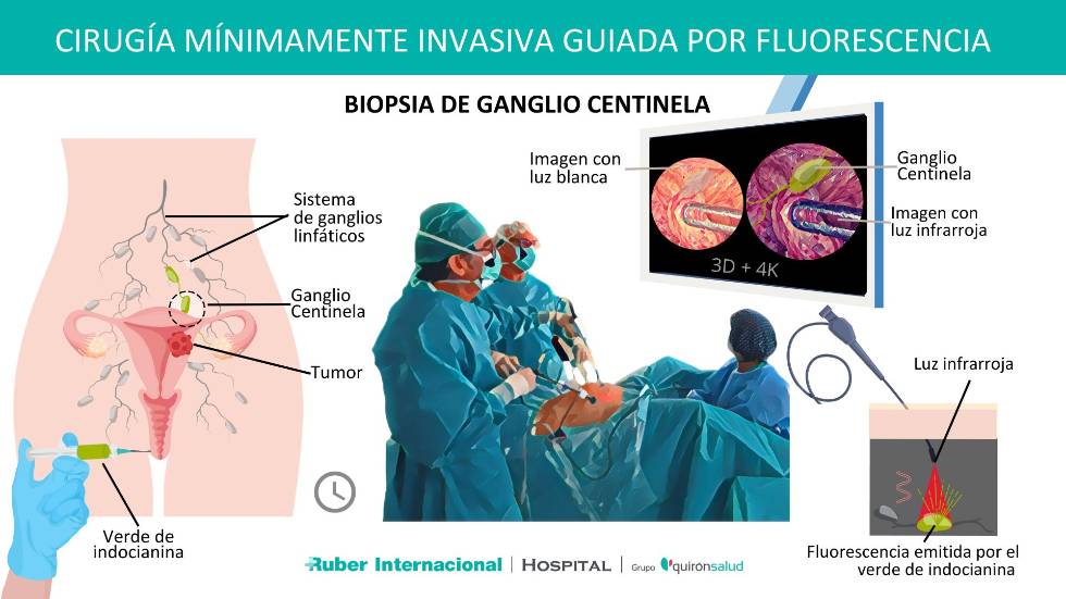 Biopsia de Ganglio centinela en cáncer de útero Cirugía mínimamente invasiva Dr Julio Álvarez