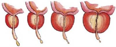 fig3-crecimiento-del-adenoma-de-prostata