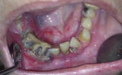 Imagen de paciente afectada de osteonecrosis mandibular por bifosfonatos
