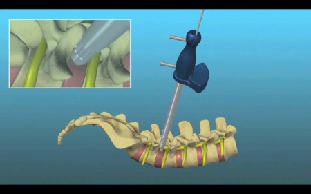 Nueva cirugía endoscópica de fusión de la columna vertebral