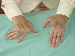 Resultado tras la cirugía de la mano izquierda en una paciente con deformidad simétrica con artritis reumatoide. Se puede ver la típica deformidad en ráfaga en la mano no operada.