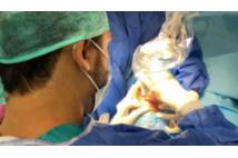 Blefaroplastia sin cirugía - Dr. Salvador Molina - Oftalmología 3
