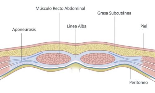 Reparación endoscópica de rectos abdominales