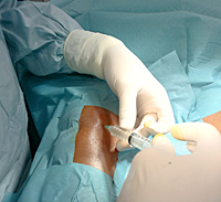 Inoculación de células madre en la rodilla del paciente