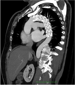 Imagen de AngioTAC que muestra la reparación endovascular del seudoaneurisma mediante la colocación de una endoprótesis a través de las arterias femorales