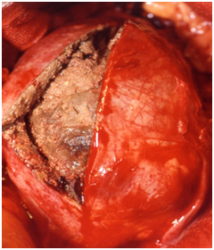 Aneurisma de aorta abdominal : segmento de aorta dilatada con trombo en su interior.
