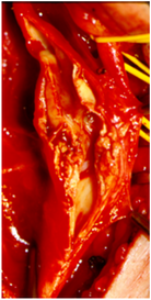 Fotografía intraoperatoria que muestra la placa de ateroma en la bifurcación carotídea
