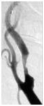 Imagen que muestra el estrechamiento en la arteria carótida interna antes del tratamiento