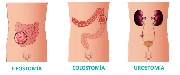 ilestomia_colostomia_urostomia