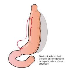 gastrectomia_vertical_madrid