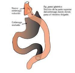 bypass_gastrico_madrid