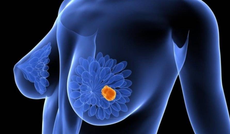 sintomas cancer de mama murcia