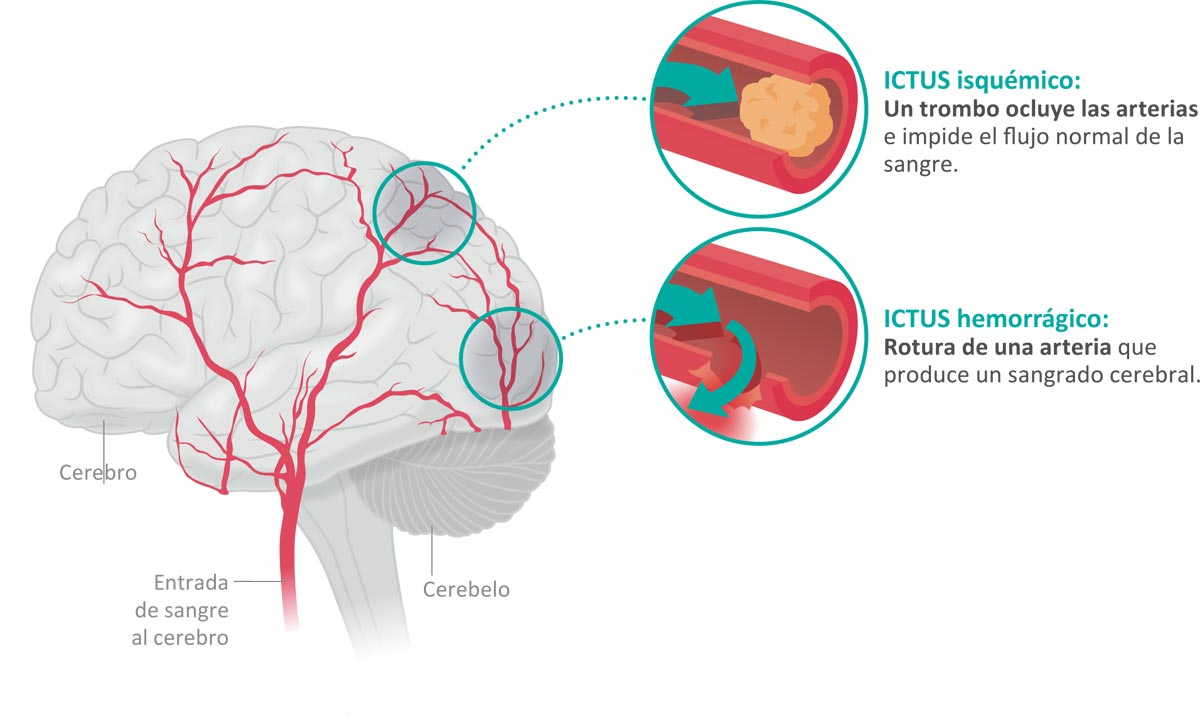 Resultado de imagen de ictus