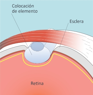 Retina-Desprendimiento-Cirugia-Escleral-paso-02-2