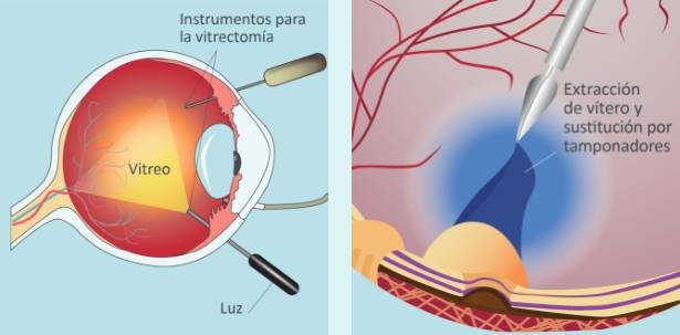 Retina-Retinopatia-Vitrectomia