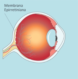 Retina-Membrana-QueEs-02