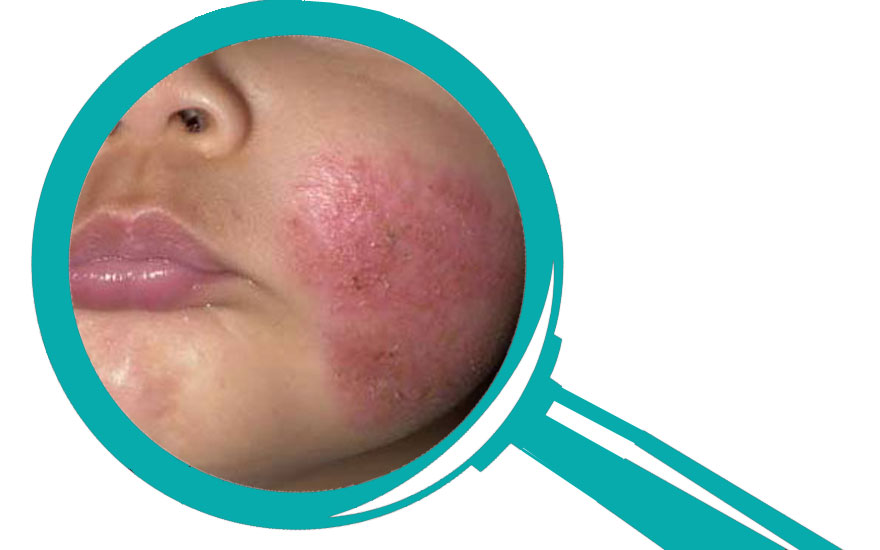 comodidad al menos Isla Stewart Qué es la dermatitis atópica y cómo se trata? | Blogs Quirónsalud
