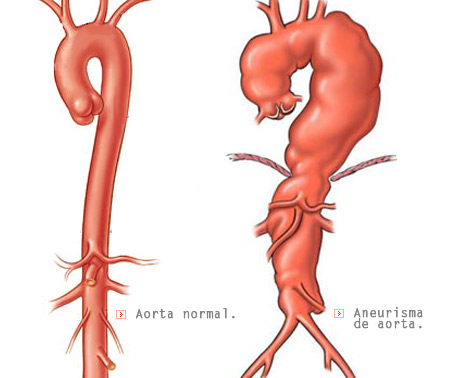 Aneurisma aorta