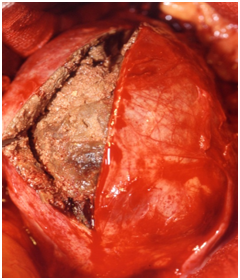 Aneurismas De Aorta Abdominal Hospital Quironsalud Barcelona