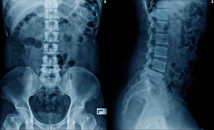 punzante la espalda, puede ser una hernia discal. Descubre los síntomas y cómo | Blogs Quirónsalud