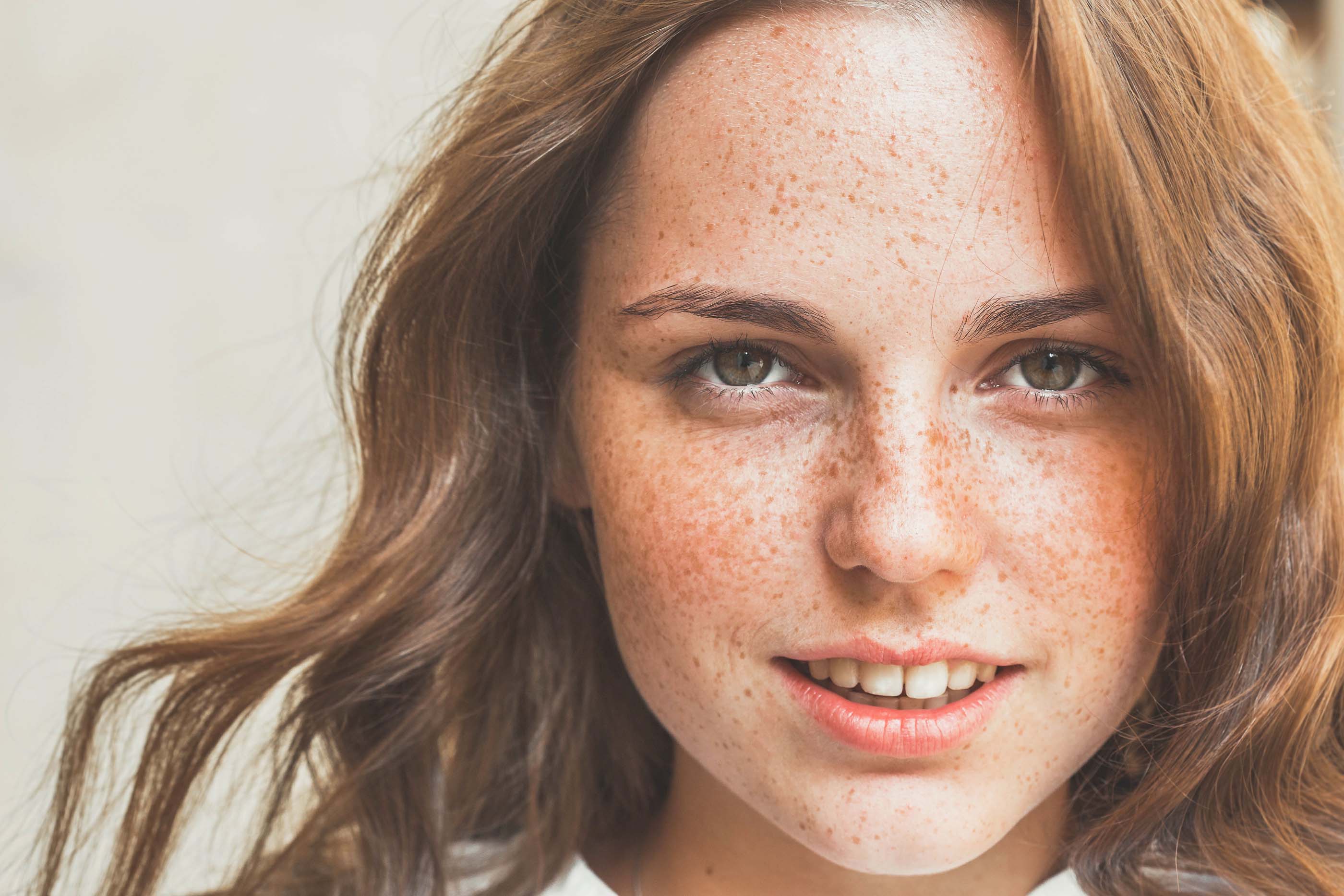 Como eliminar las pecas de la cara en un dia Trastornos De La Pigmentacion I Causas Y Tipos Blogs Quironsalud