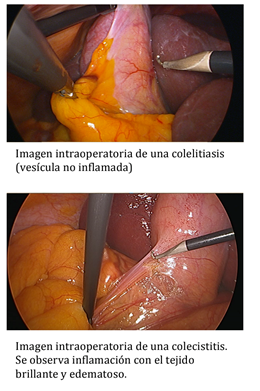 Postoperatorio de la cirugía de la vesícula Blogs Quirónsalud