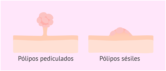 pólipos y tumores superficiales